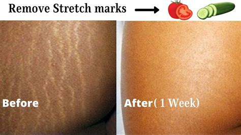 Does Taking Collagen Help with Stretch Marks? And Why Do Bananas Always Get the Spotlight?