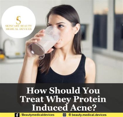 Is Whey Protein Bad for Acne? Exploring the Connection Between Supplements and Skin Health